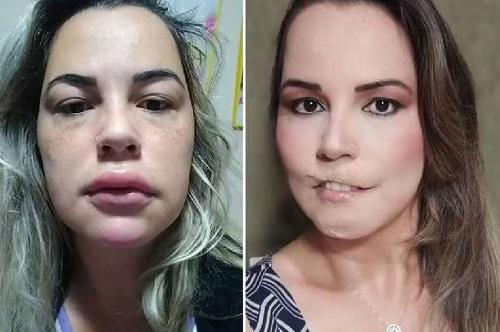 Médicos são proibidos de usar PMMA em procedimentos estéticos; veja nova regra