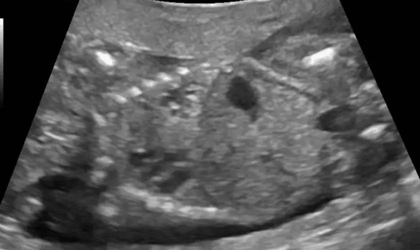 Adolescente asfixia e joga bebê prematuro no lixo ao forçar aborto