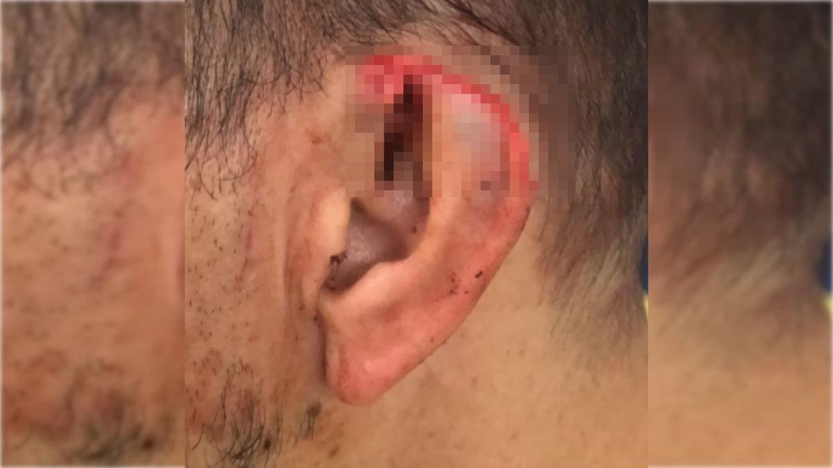 Homem arranca parte da orelha do namorado durante briga no DF