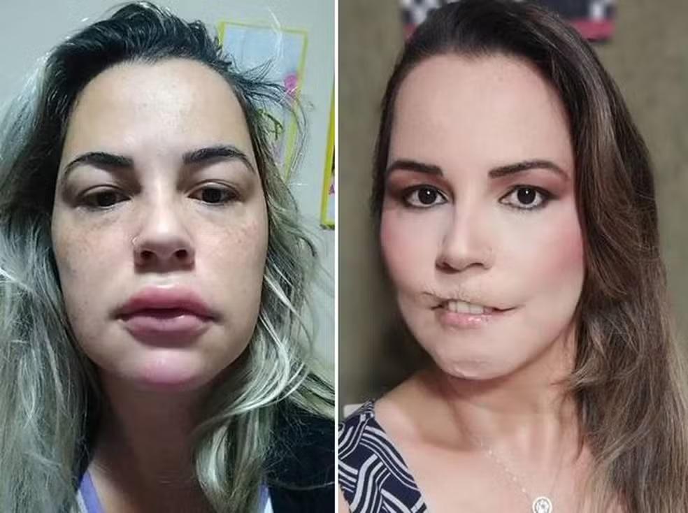 Médicos são proibidos de usar PMMA em procedimentos estéticos; veja nova regra